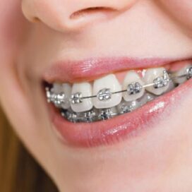 dis-teli-yetiskin-ortodonti